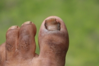 Managing Fungal Toenails