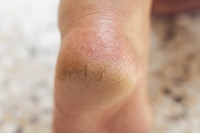 Causes and Risk Factors for Cracked Heels