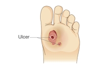 Three Phases of Diabetic Wound Healing