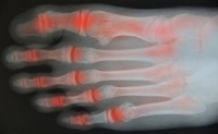 Types and Causes of Foot Arthritis